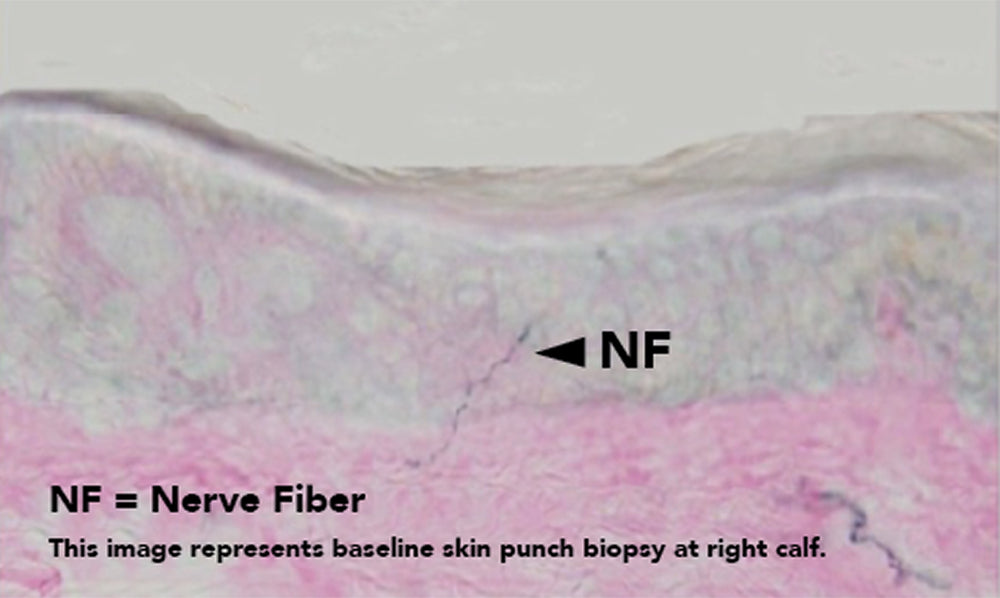 Microscopic image of a skin punch biopsy with nerve fibers labeled, on a light gray background.