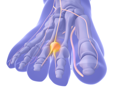 Metanx FC™ for Peripheral Neuropathy